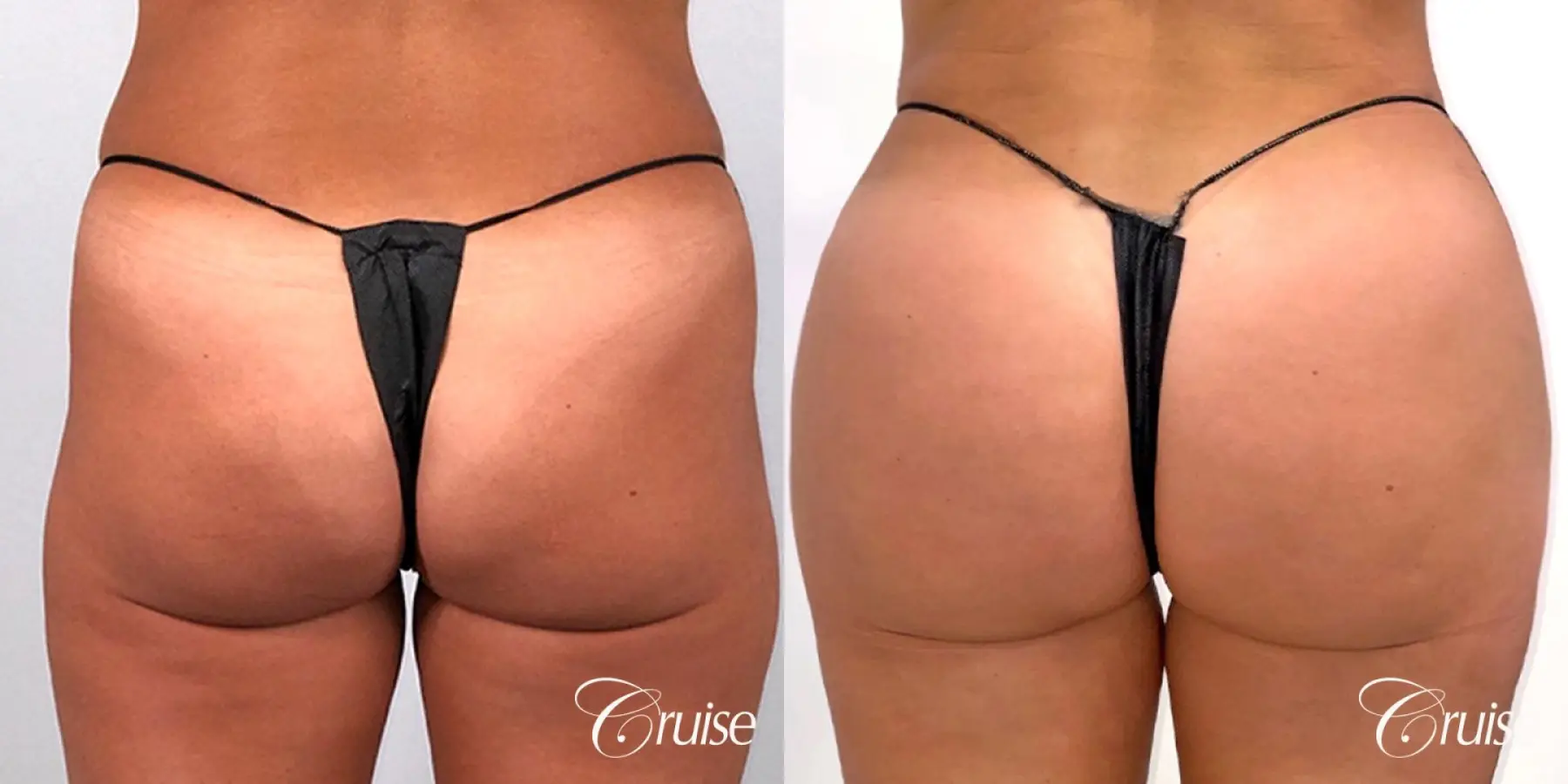 Brazilian Butt Lift with Liposuction to Stomach & Flanks - Before and After