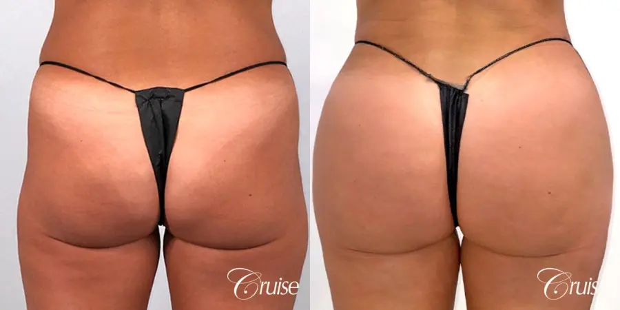 Brazilian Butt Lift with Liposuction to Stomach & Flanks - Before and After 1