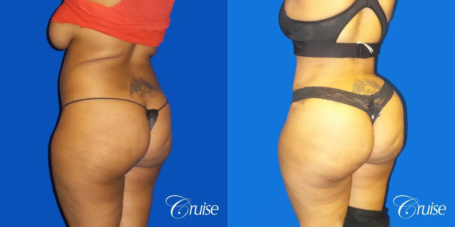 Brazilian Butt Lift - Before and After 1