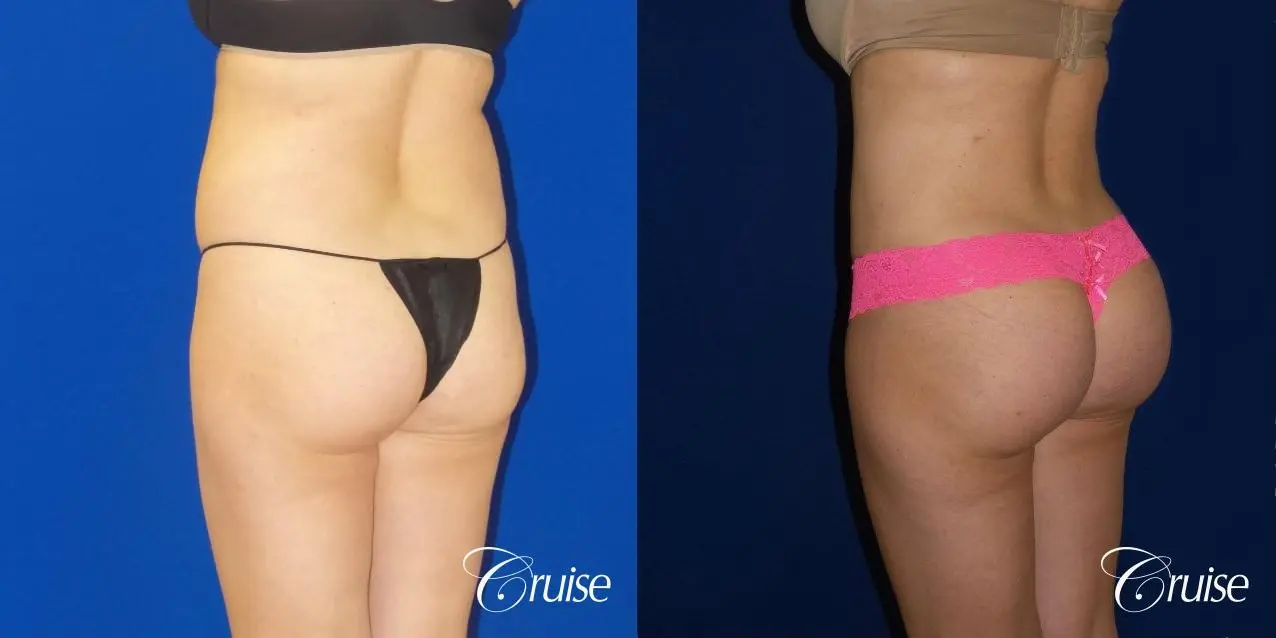 Brazilian Butt Lift - Before and After  