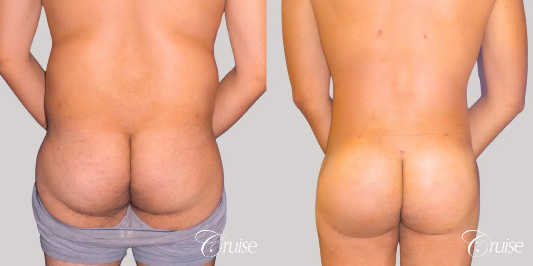 Brazilian Butt Lift: Patient 1 - Before and After 1