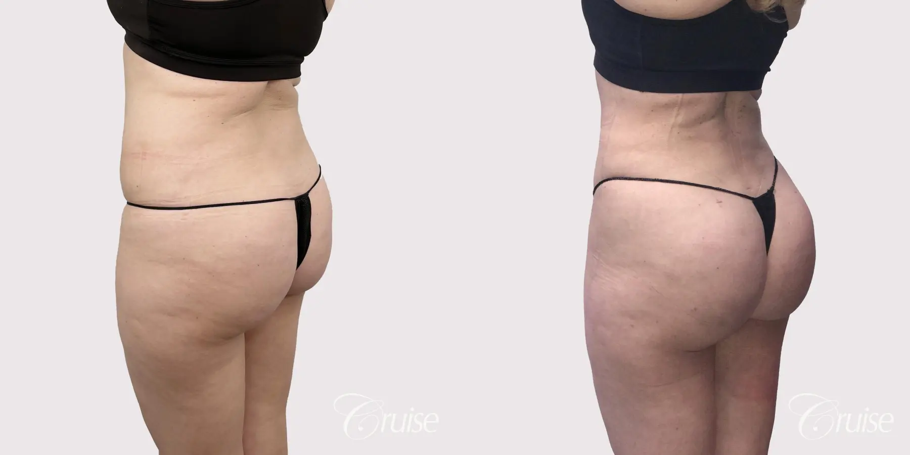 Brazilian Butt Lift: Patient 2 - Before and After  