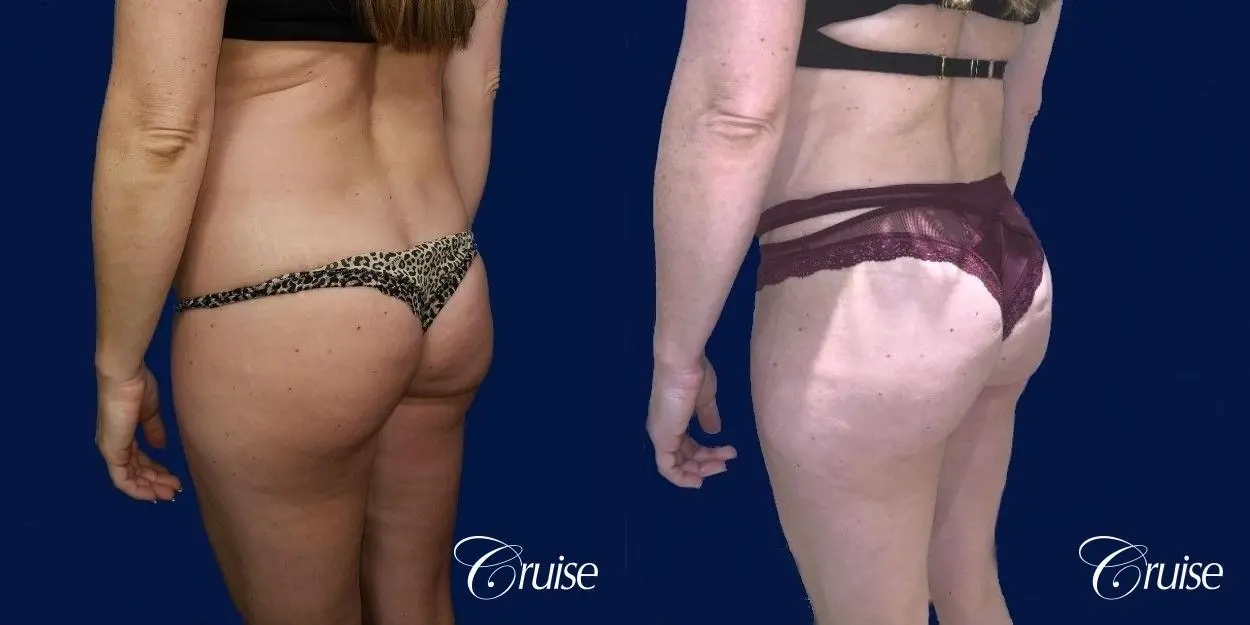 Brazilian Butt Lift - Before and After 3