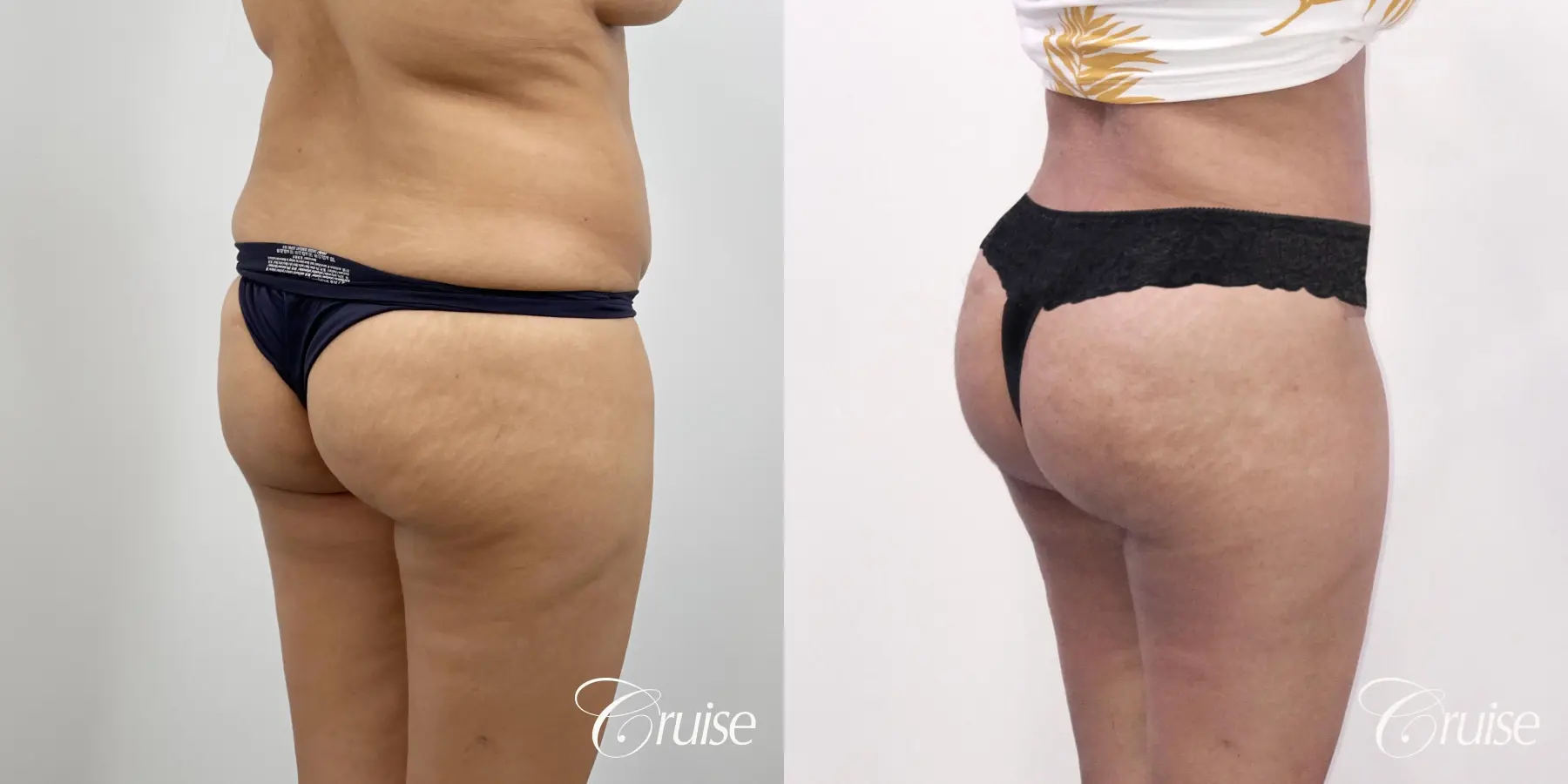 Brazilian Butt Lift: Patient 22 - Before and After 4