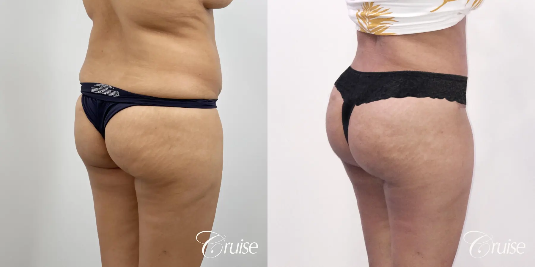 Brazilian Butt Lift: Patient 25 - Before and After 4