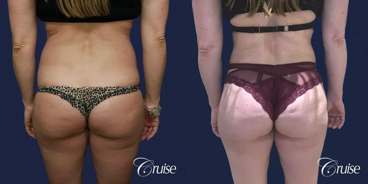 Brazilian Butt Lift - Before and After 1