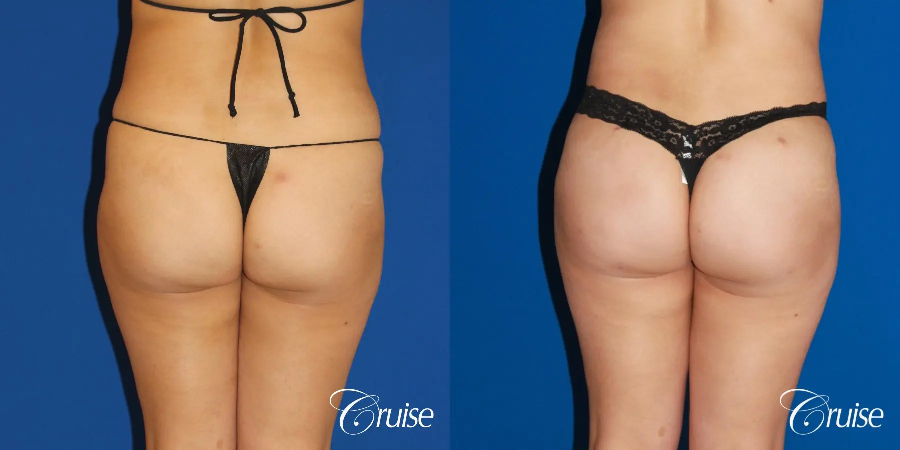 Brazilian Butt Lift, Lipo Flanks and Thighs - Before and After 1