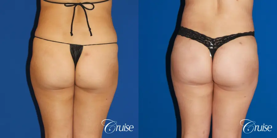 Brazilian Butt Lift, Lipo Flanks and Thighs - Before and After  