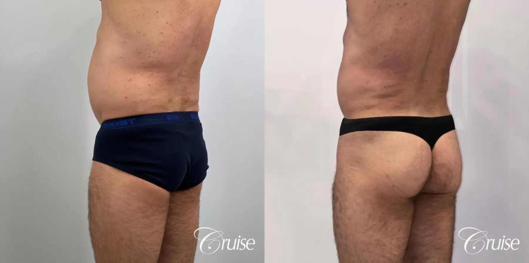 Brazilian Butt Lift: Patient 24 - Before and After  
