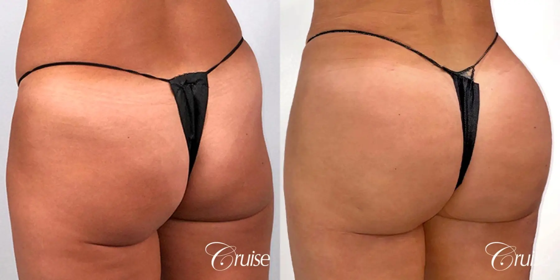 Brazilian Butt Lift with Liposuction to Stomach & Flanks - Before and After 2