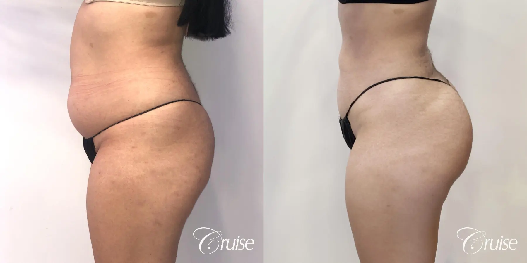 Brazilian Butt Lift: Patient 25 - Before and After 2