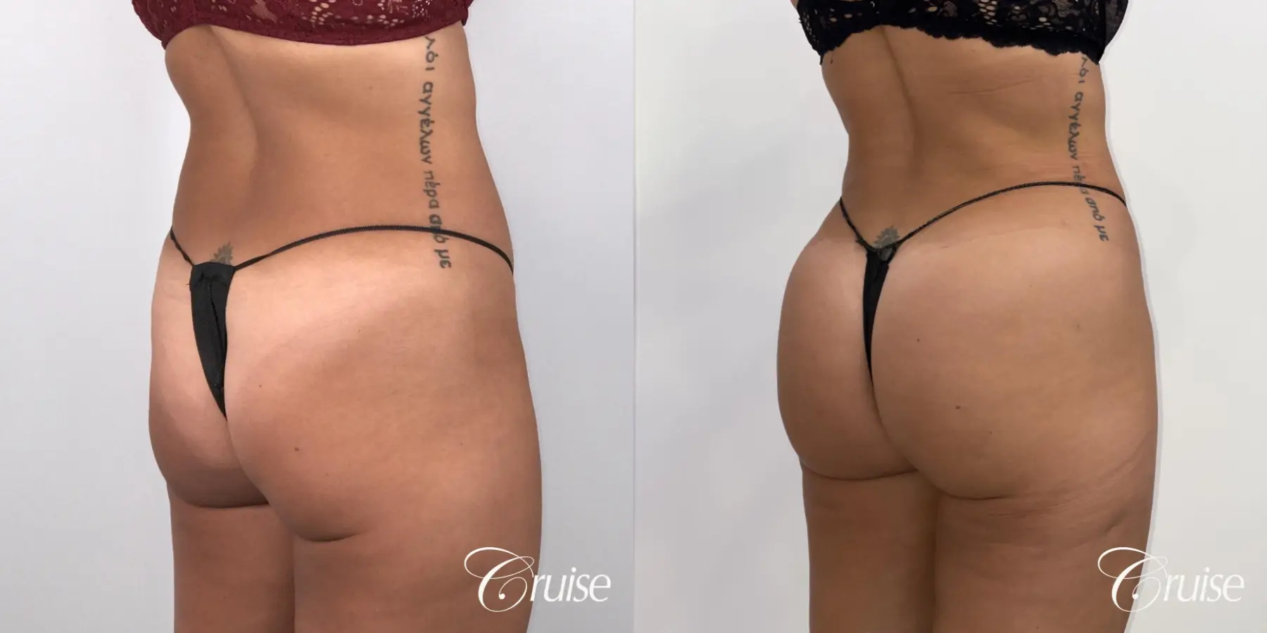 Brazilian Butt Lift: Patient 28 - Before and After 1