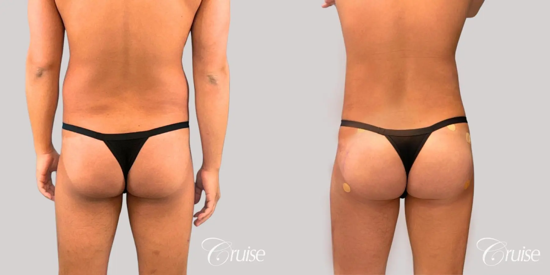 Brazilian Butt Lift: Patient 30 - Before and After 2
