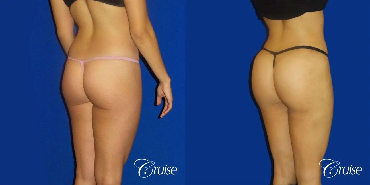 Brazilian Butt Lift - Before and After  