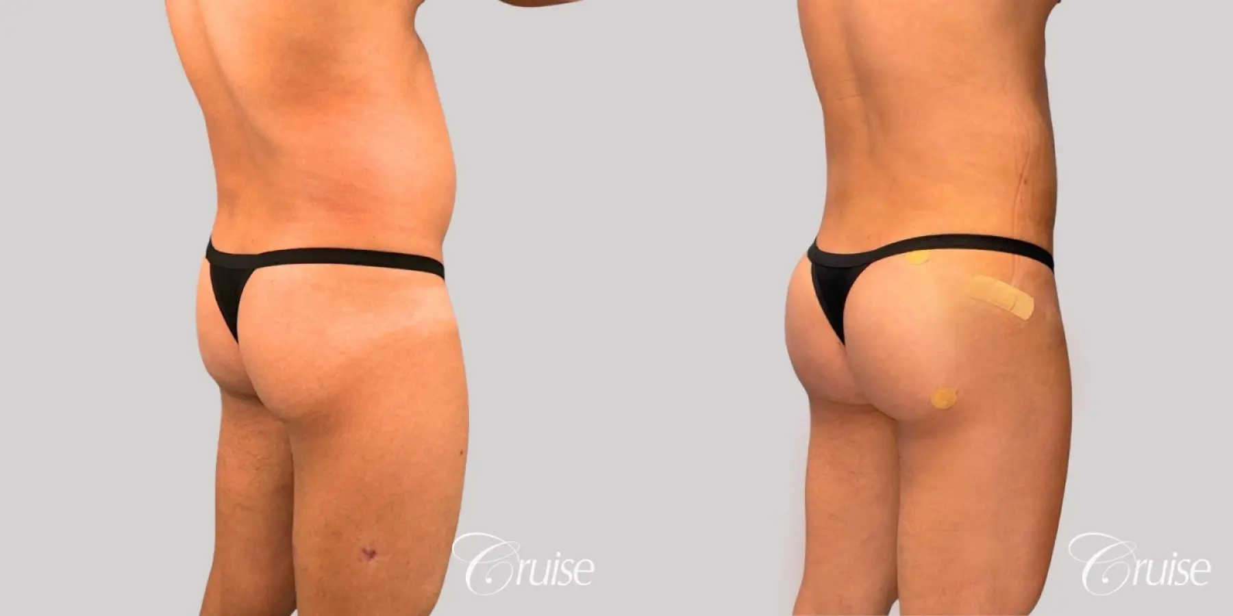 Brazilian Butt Lift: Patient 30 - Before and After 1