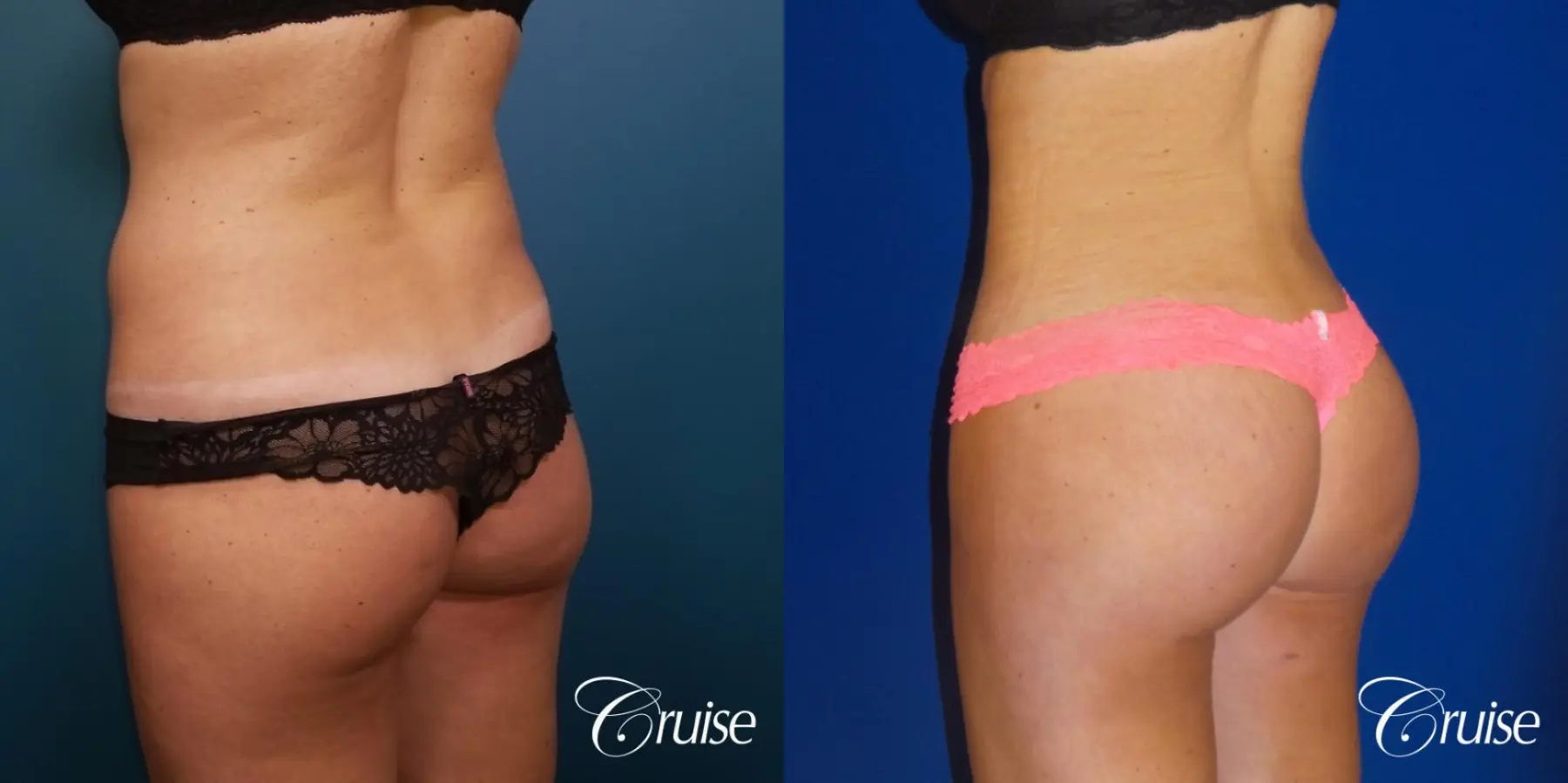 Brazilian Butt Lift: Patient 4 - Before and After 3