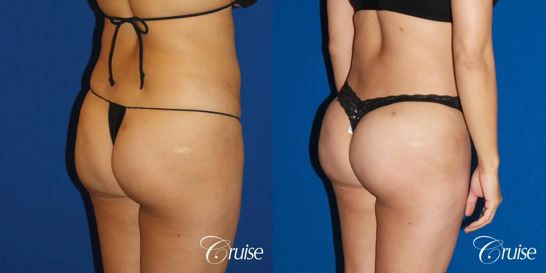 Brazilian Butt Lift, Lipo Flanks and Thighs - Before and After 3