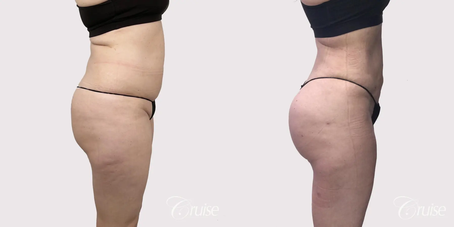 Brazilian Butt Lift: Patient 2 - Before and After 4
