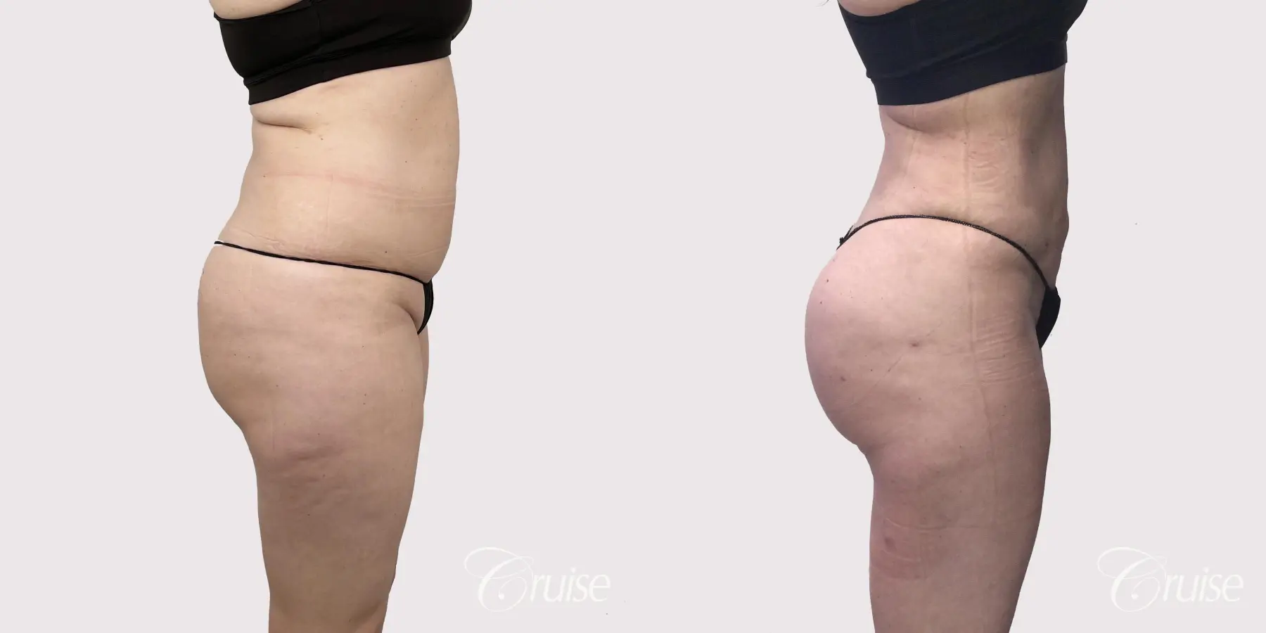 Brazilian Butt Lift Before After Gallery Patient 2