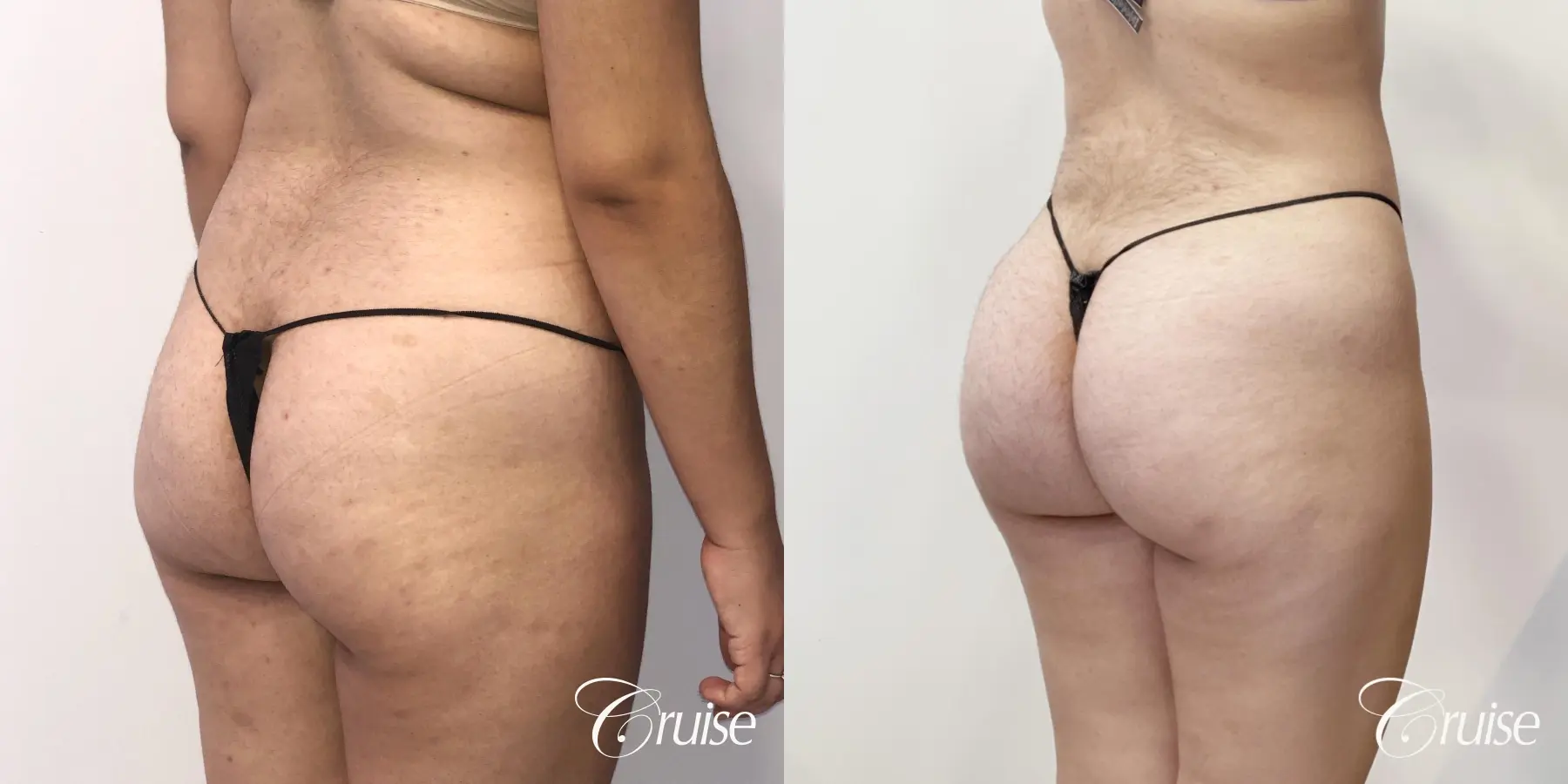 Brazilian Butt Lift: Patient 25 - Before and After 5