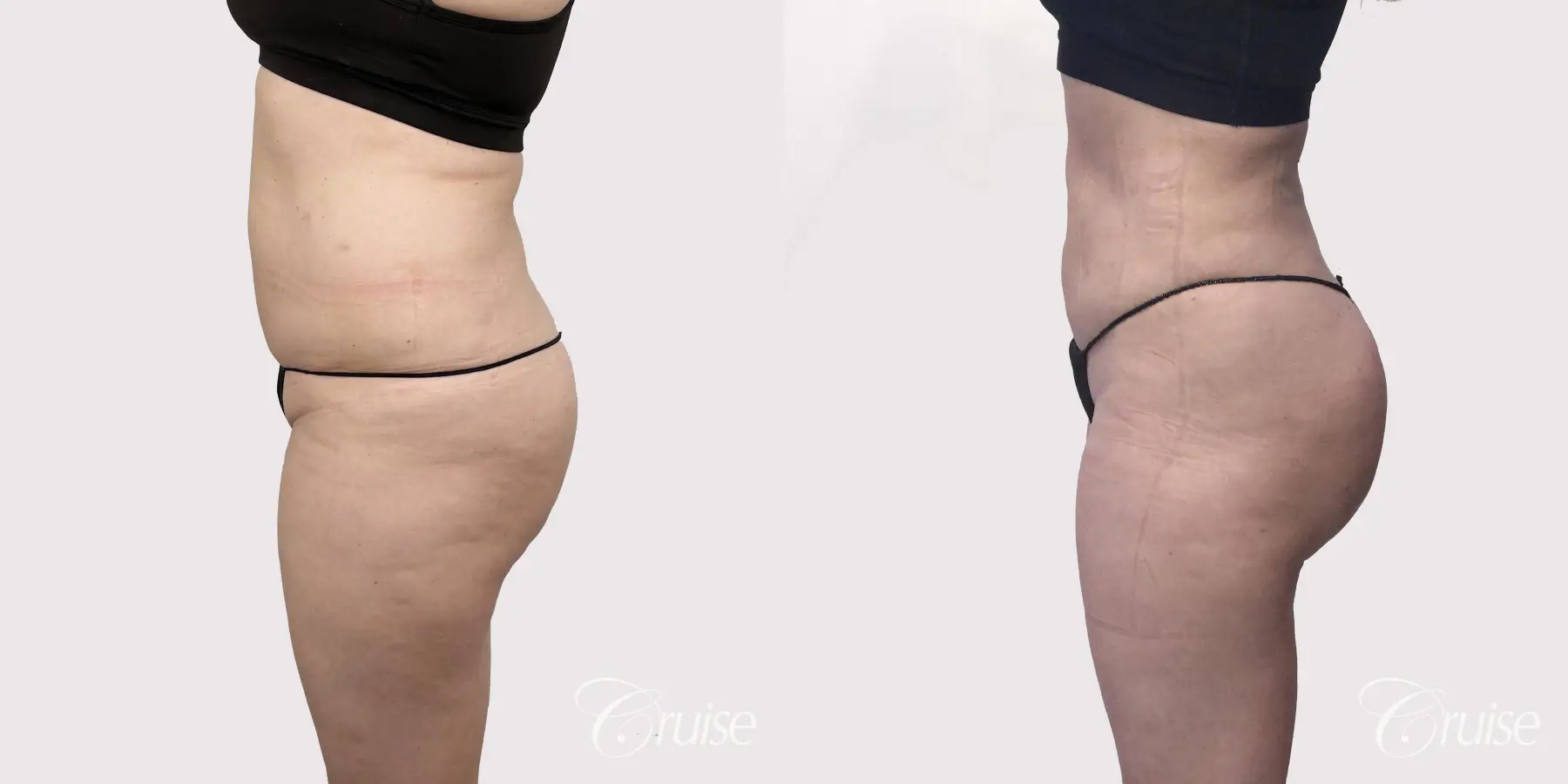 Brazilian Butt Lift: Patient 6 - Before and After 2
