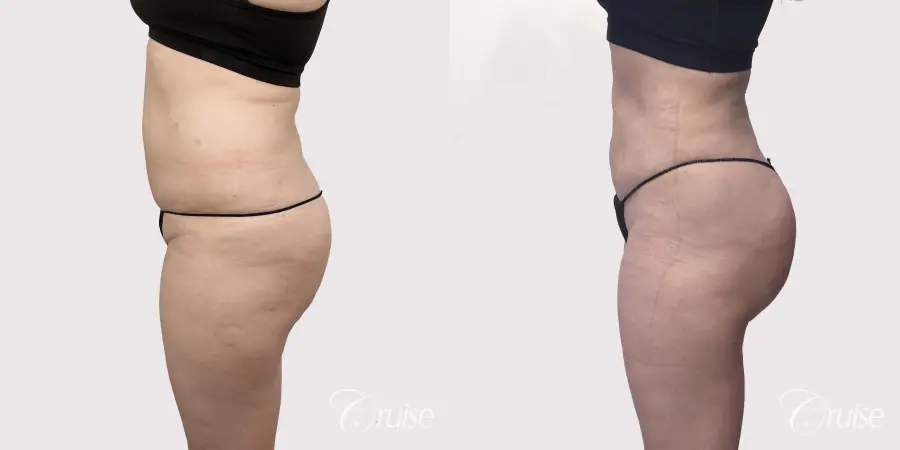 Brazilian Butt Lift: Patient 2 - Before and After 2