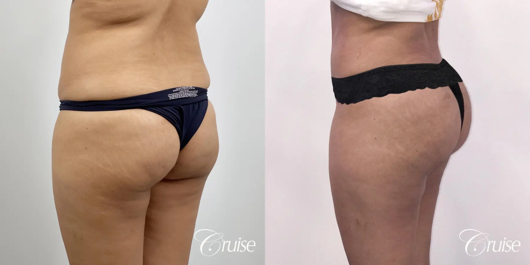 Brazilian Butt Lift: Patient 25 - Before and After 3