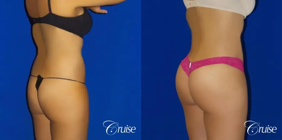 Brazilian Butt Lift - Before and After 2