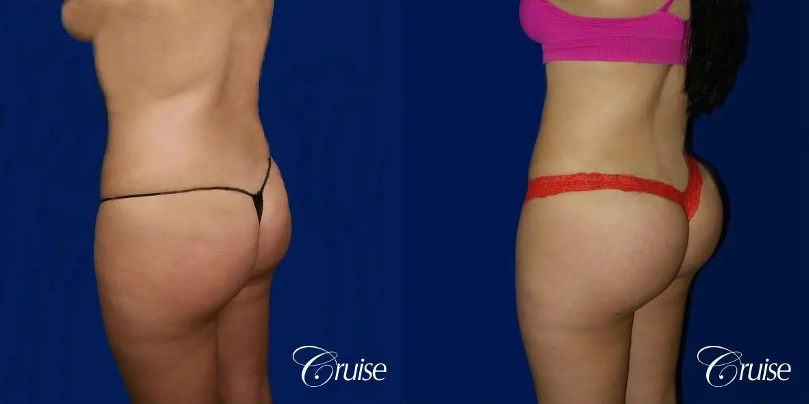 Brazilian Butt Lift - Before and After 2