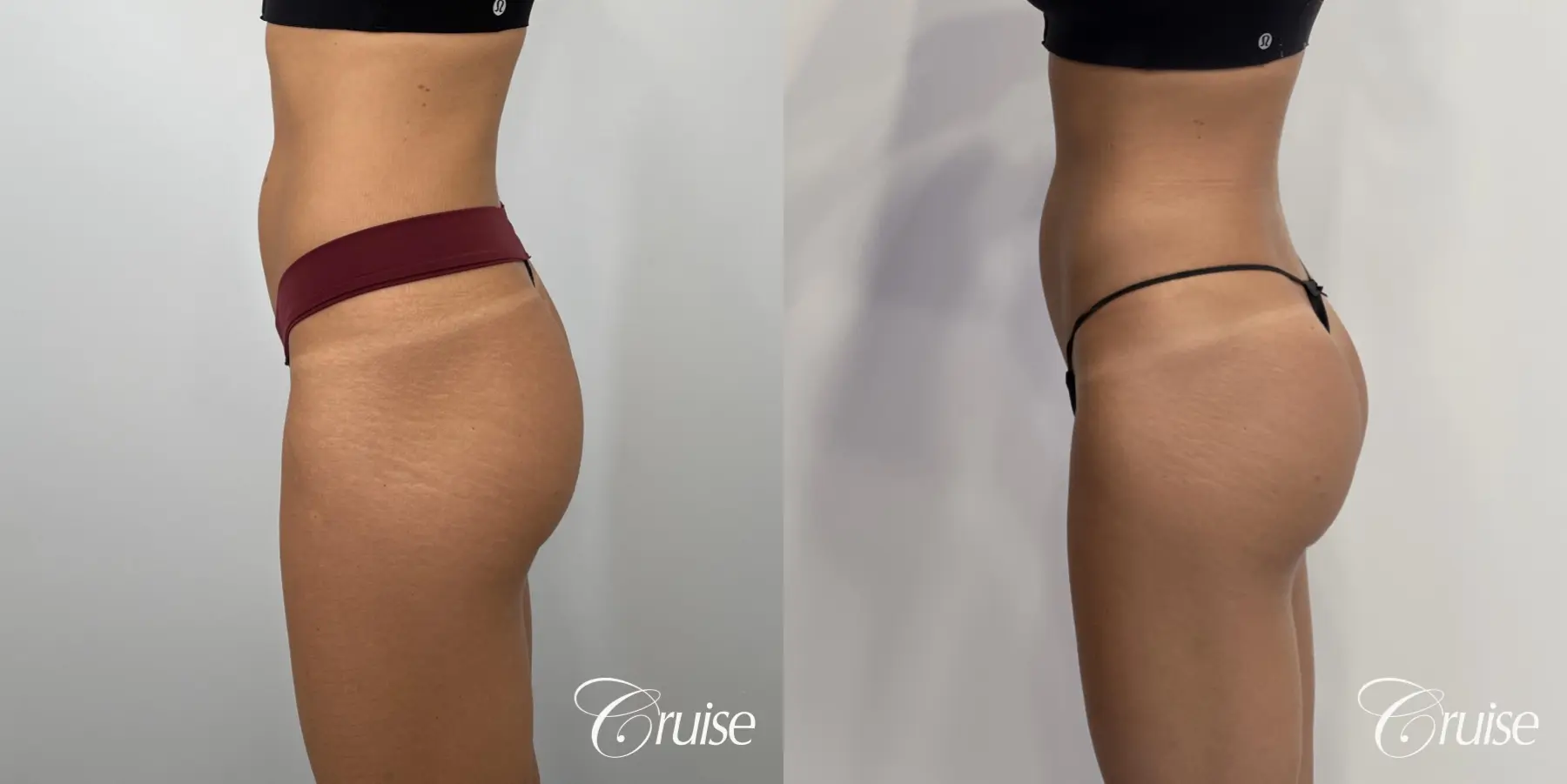 Brazilian Butt Lift: Patient 21 - Before and After 2
