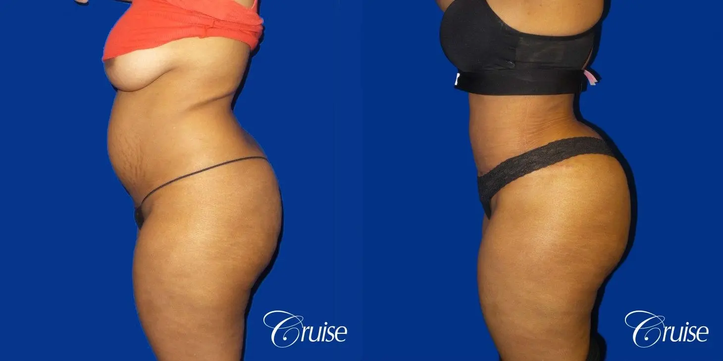 Brazilian Butt Lift - Before and After 2