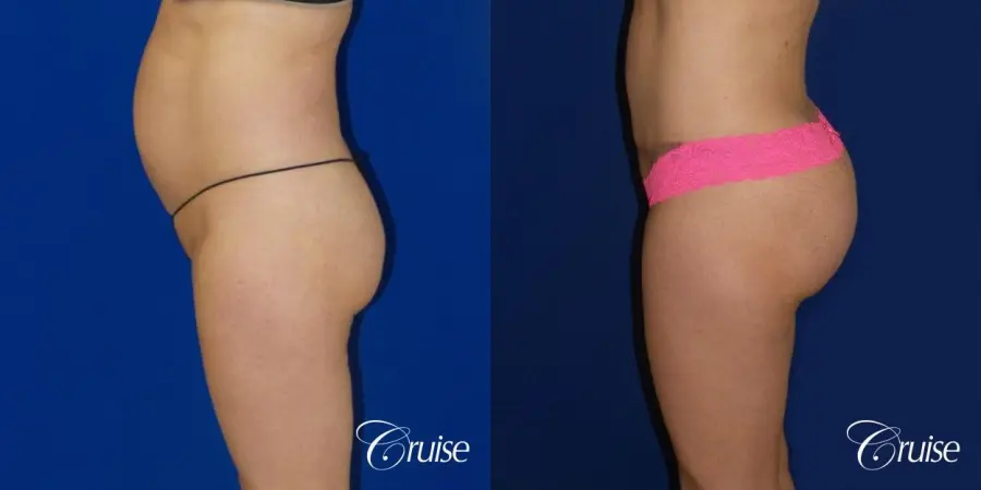 Brazilian Butt Lift - Before and After 2