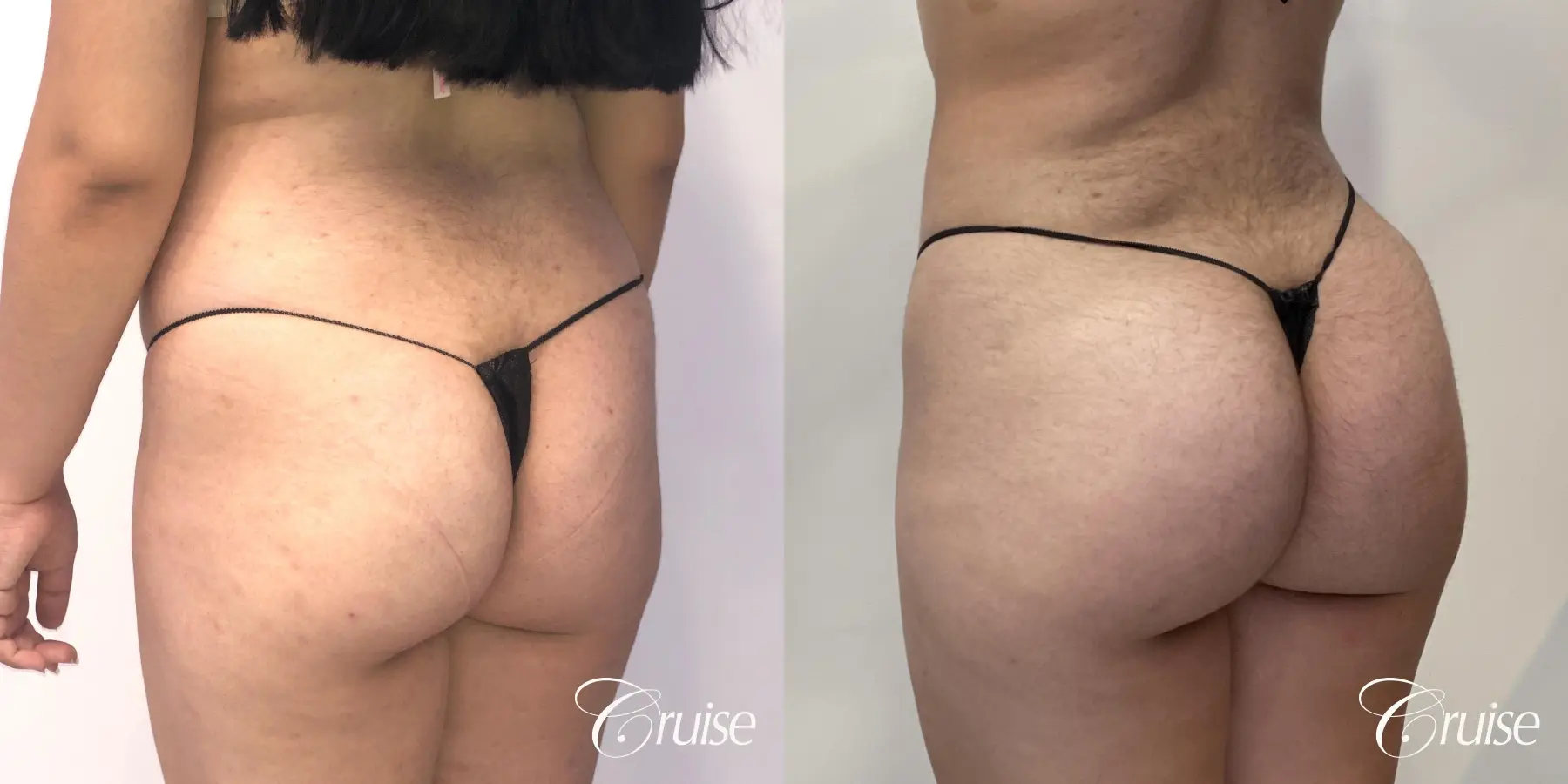 Brazilian Butt Lift: Patient 25 - Before and After 1