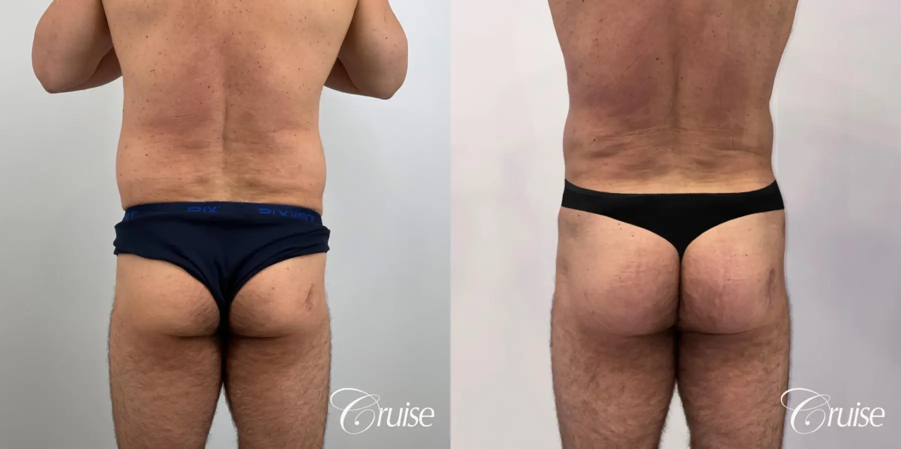 Brazilian Butt Lift: Patient 24 - Before and After 2
