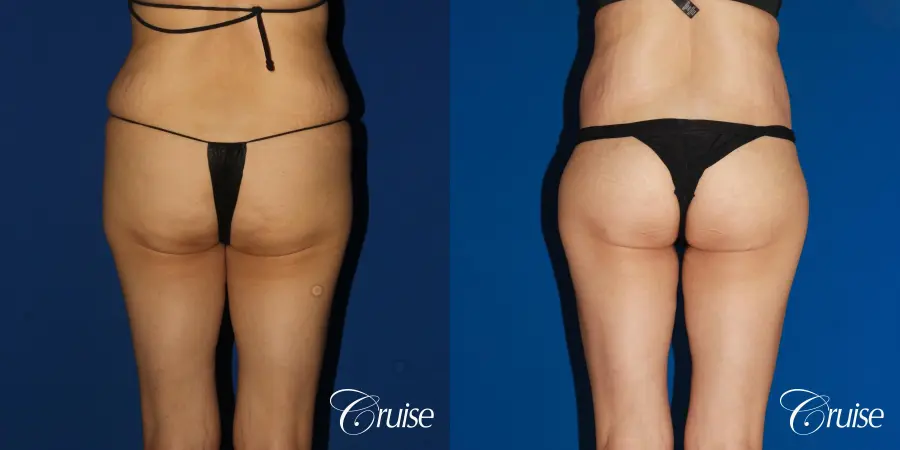 BBL, Lipo Flanks and Circumferential Tummy Tuck - Before and After