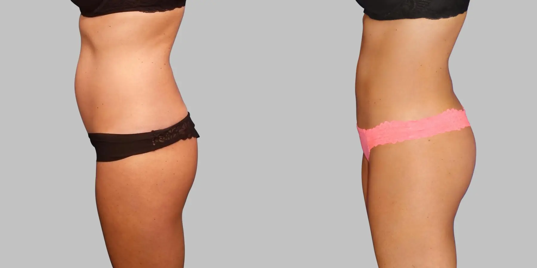 Brazilian Butt Lift: Patient 5 - Before and After 3