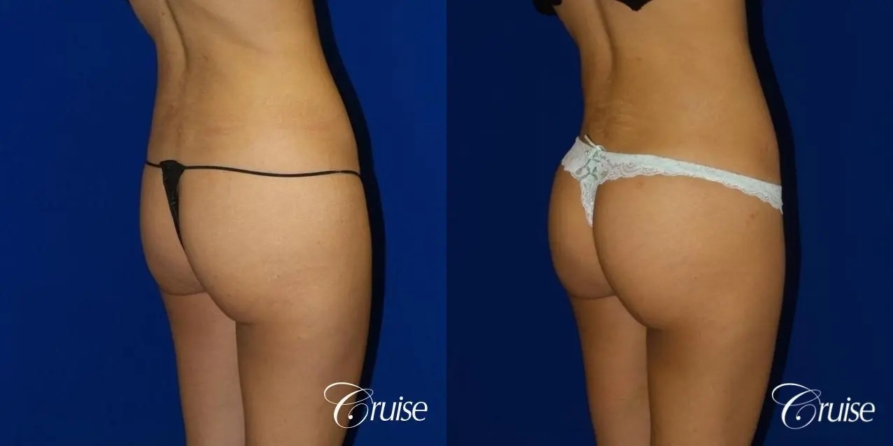 Brazilian Butt Lift Before & After Gallery: Patient 12