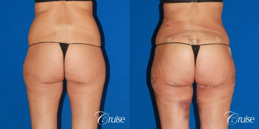 BBL, Lipo Flanks and Thighs - Before and After