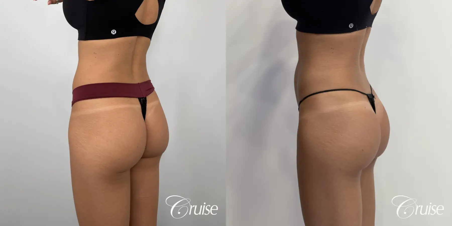 Brazilian Butt Lift: Patient 24 - Before and After 1