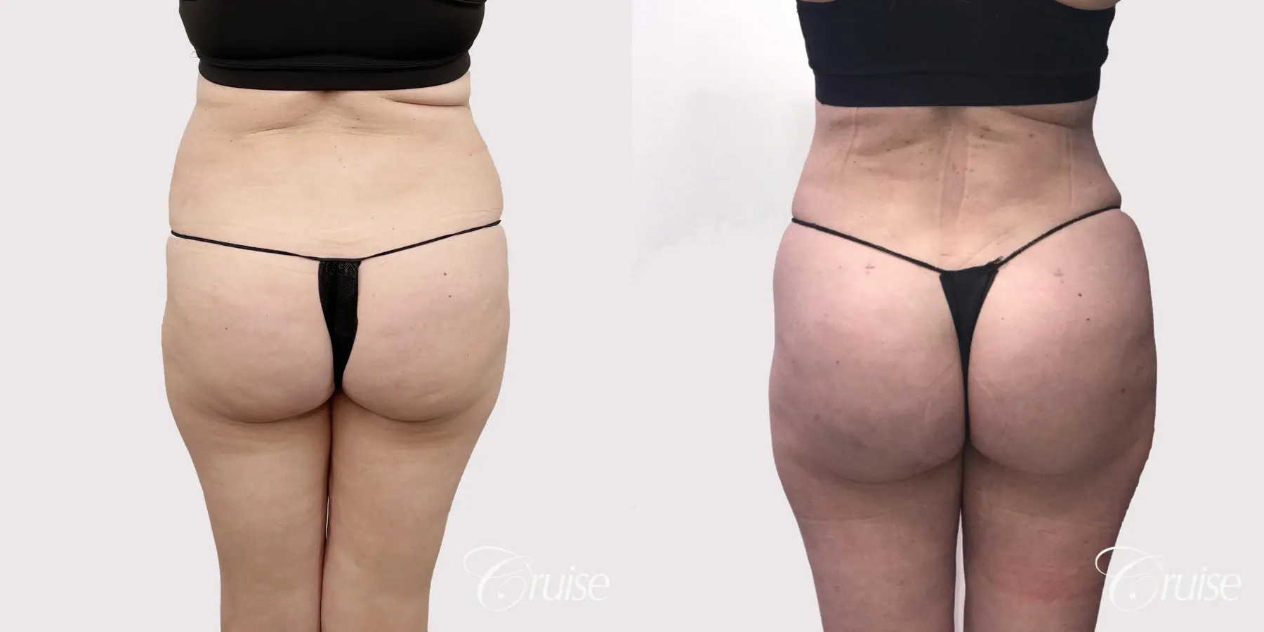 Brazilian Butt Lift: Patient 2 - Before and After 3