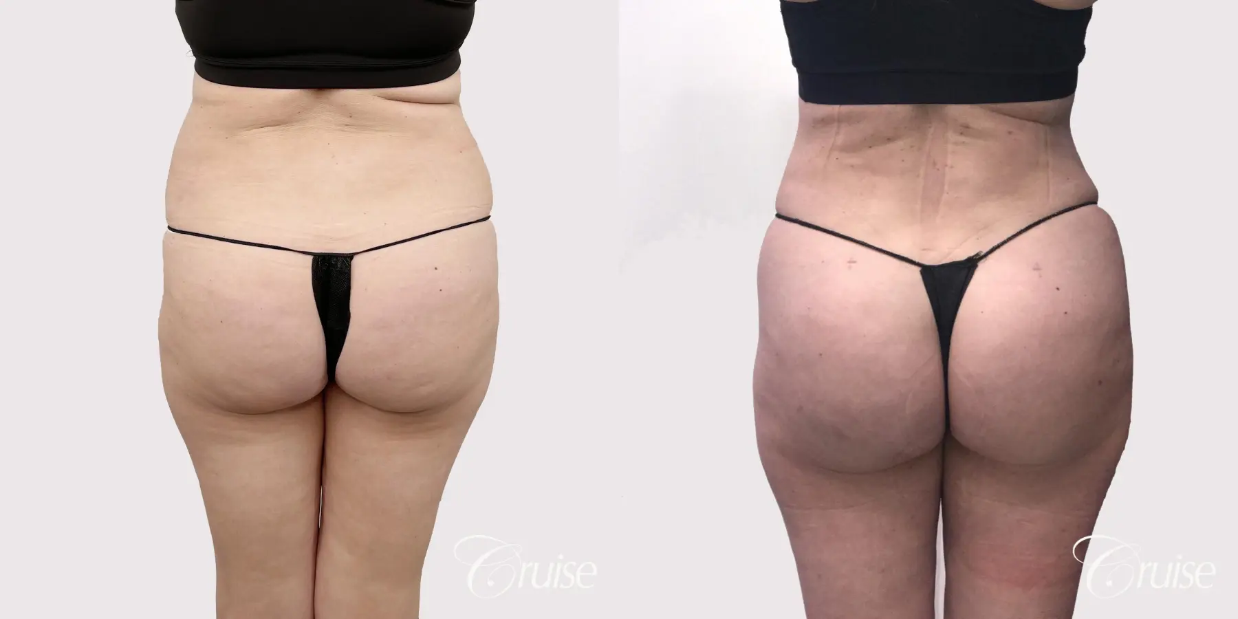 Brazilian Butt Lift: Patient 6 - Before and After 3