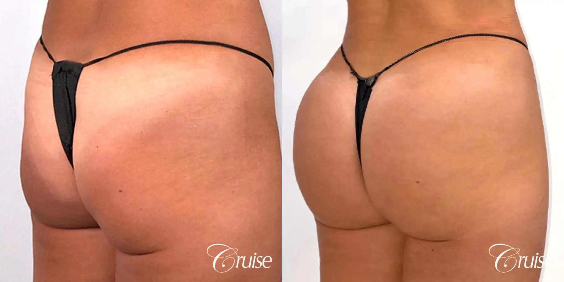 Brazilian Butt Lift with Liposuction to Stomach & Flanks - Before and After 3