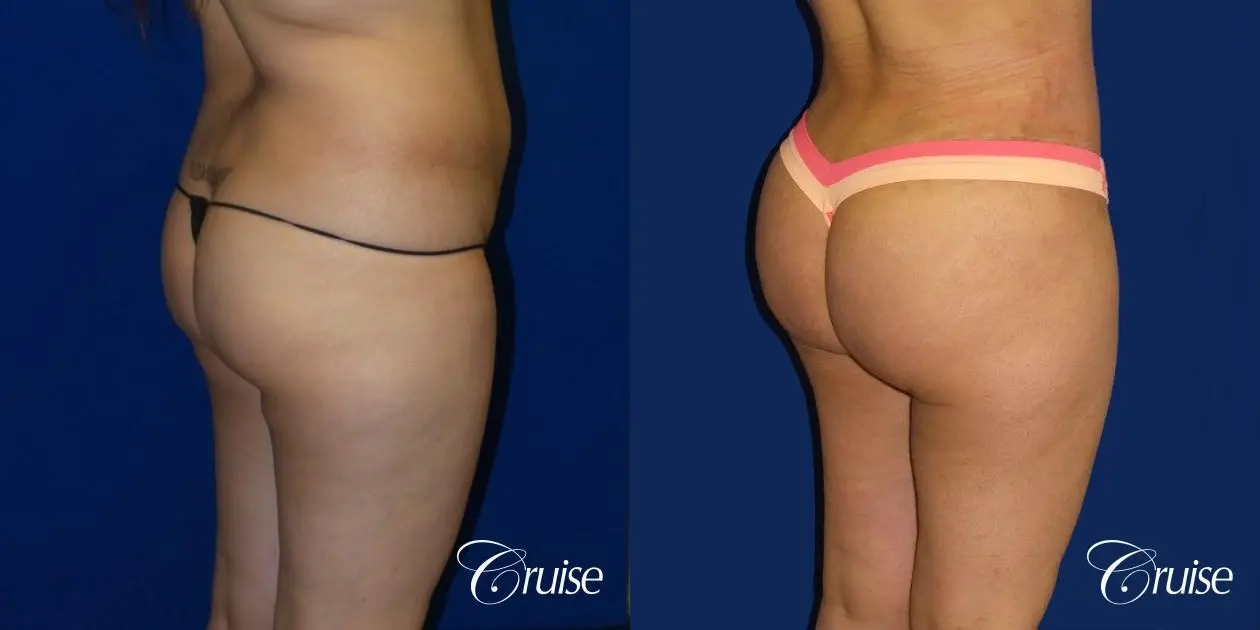 Brazilian Butt Lift - Before and After 3