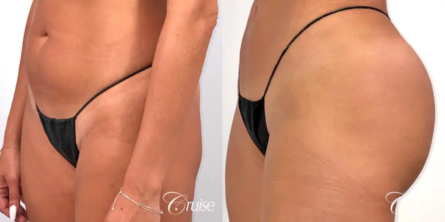 Brazilian Butt Lift with Liposuction to Stomach & Flanks - Before and After 4