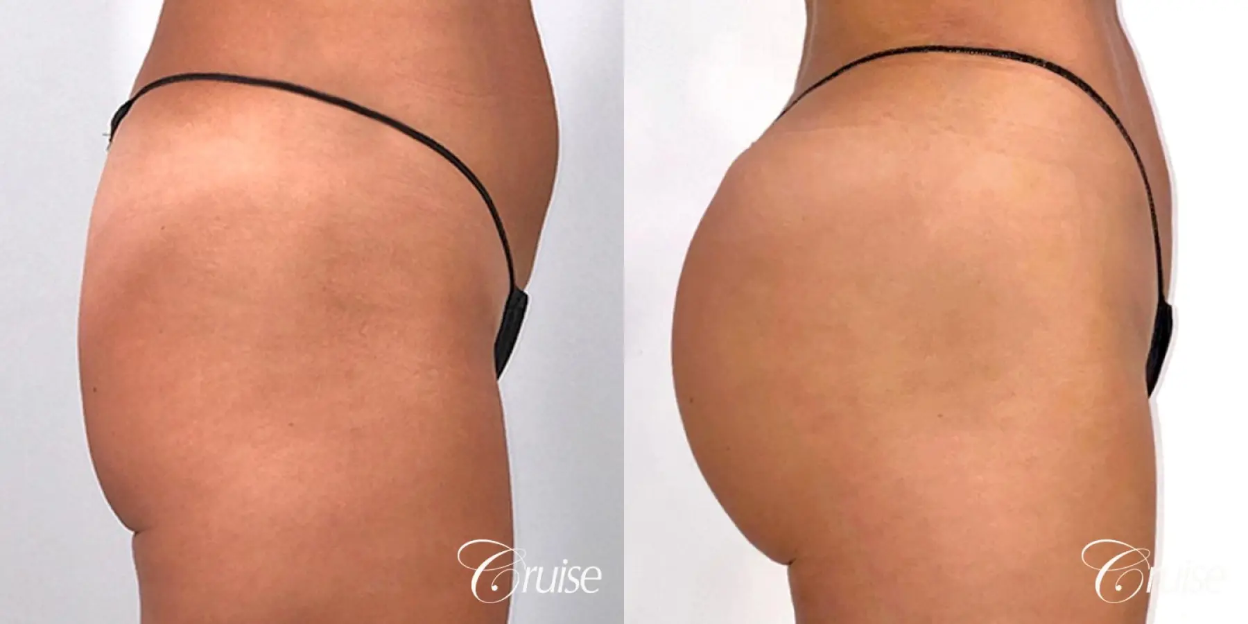 Brazilian Butt Lift with Liposuction to Stomach & Flanks - Before and After 6