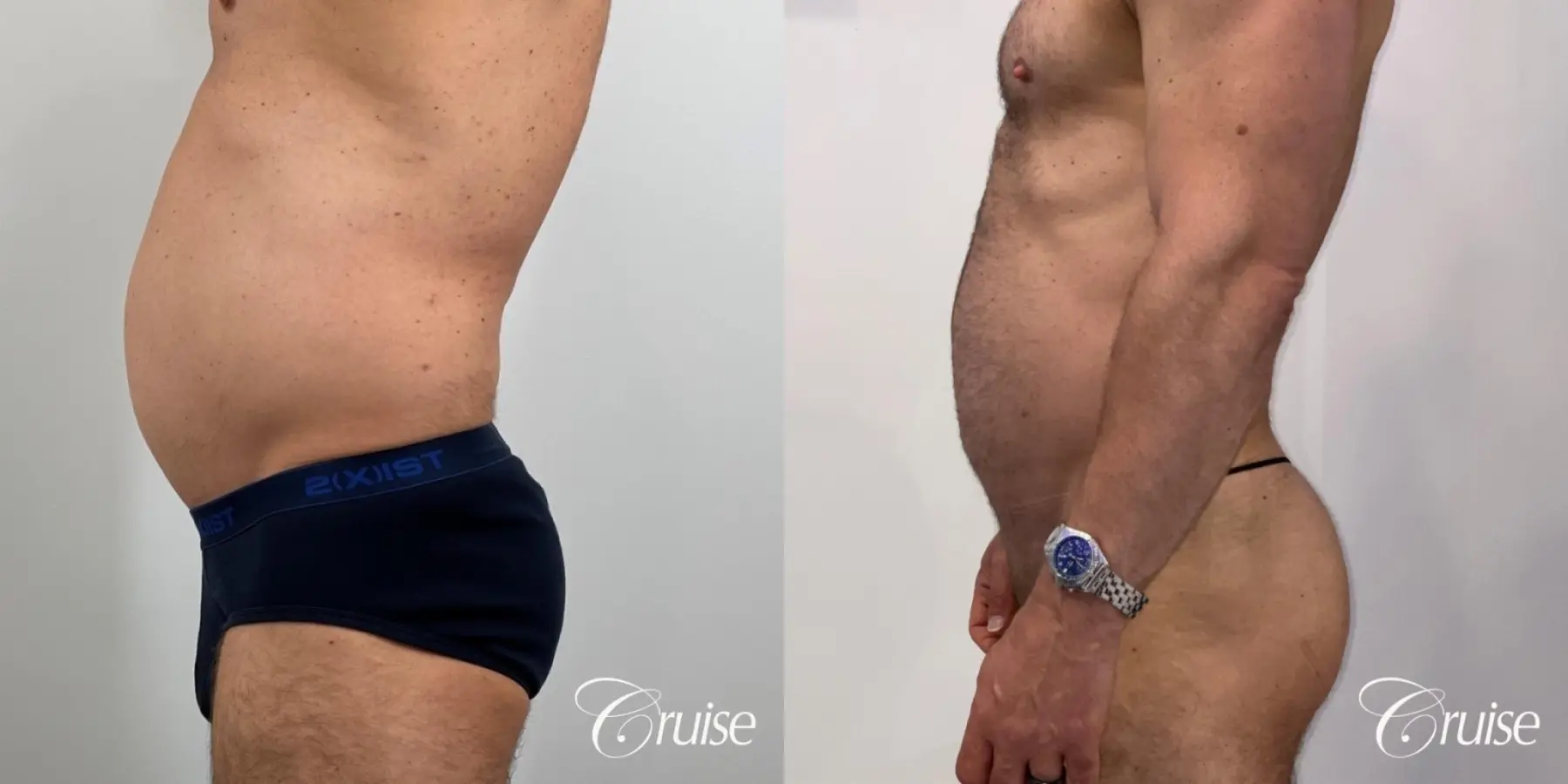 Brazilian Butt Lift: Patient 26 - Before and After 5