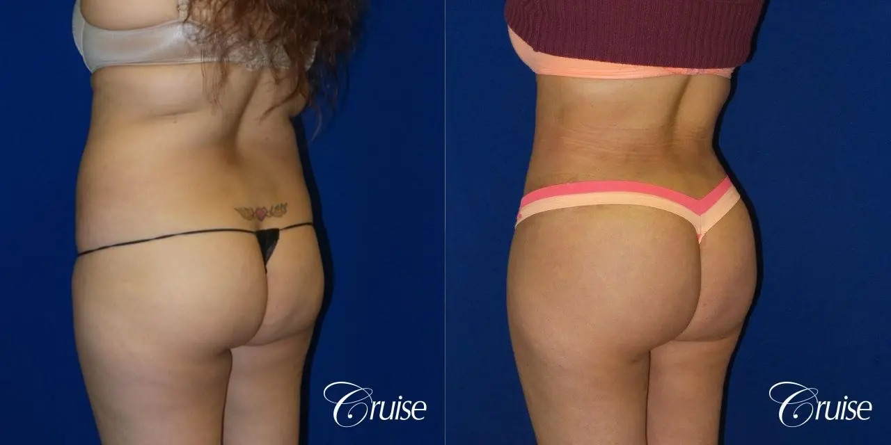 Brazilian Butt Lift - Before and After 1