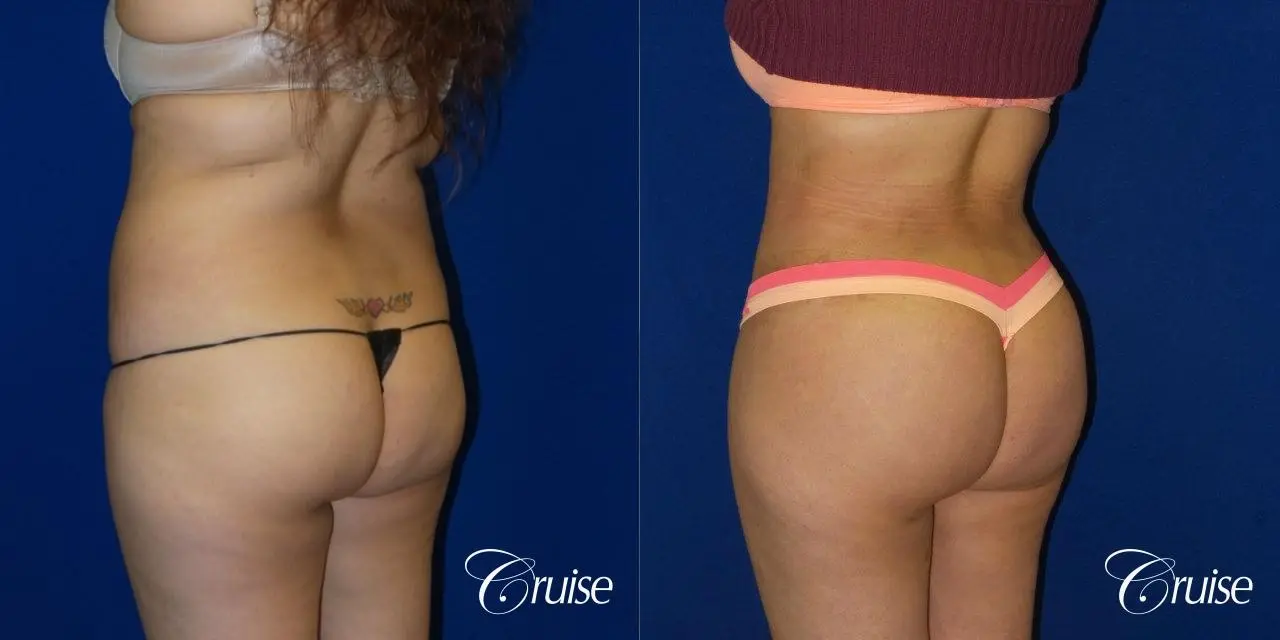 Brazilian Butt Lift - Before and After  