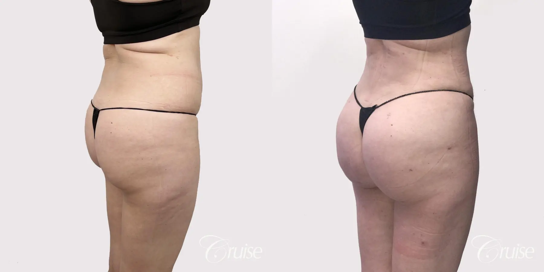Brazilian Butt Lift: Patient 6 - Before and After 5