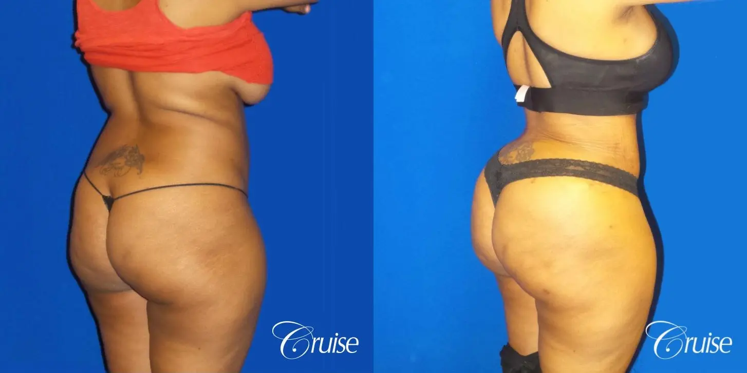 Brazilian Butt Lift - Before and After 3